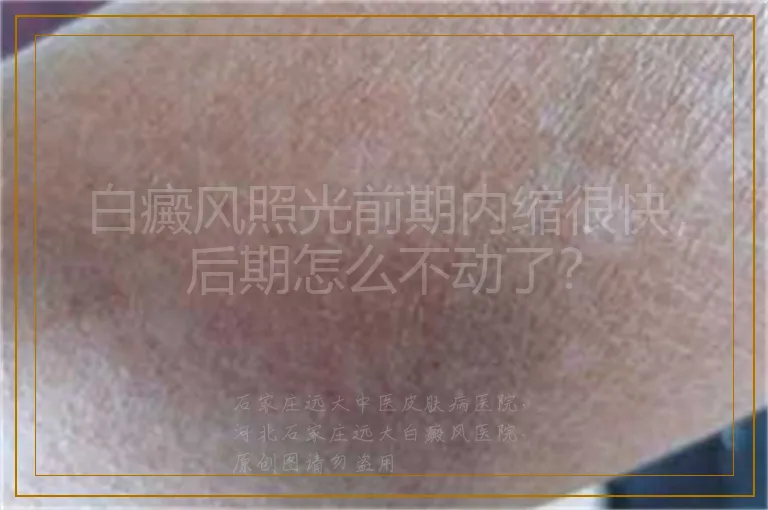 白癜风照光前期内缩很快，后期怎么不动了？