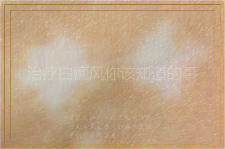 治疗白癜风你该知道的事