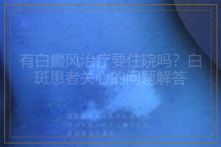 有白癜风治疗要住院吗？白斑患者关心的问题解答