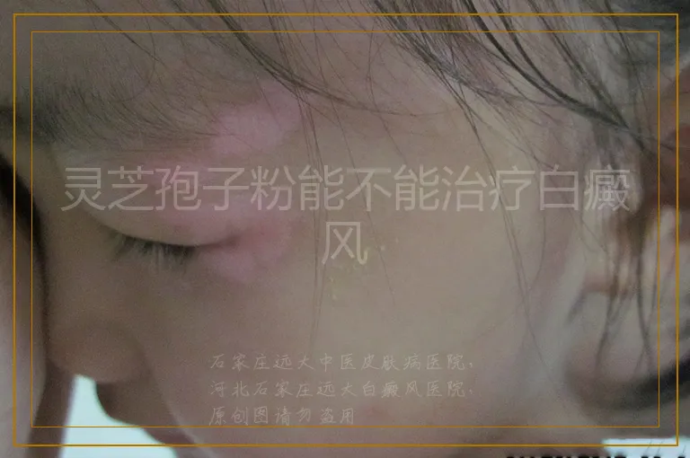 灵芝孢子粉能不能治疗白癜风