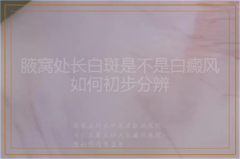 腋窝处长白斑是不是白癜风如何初步分辨