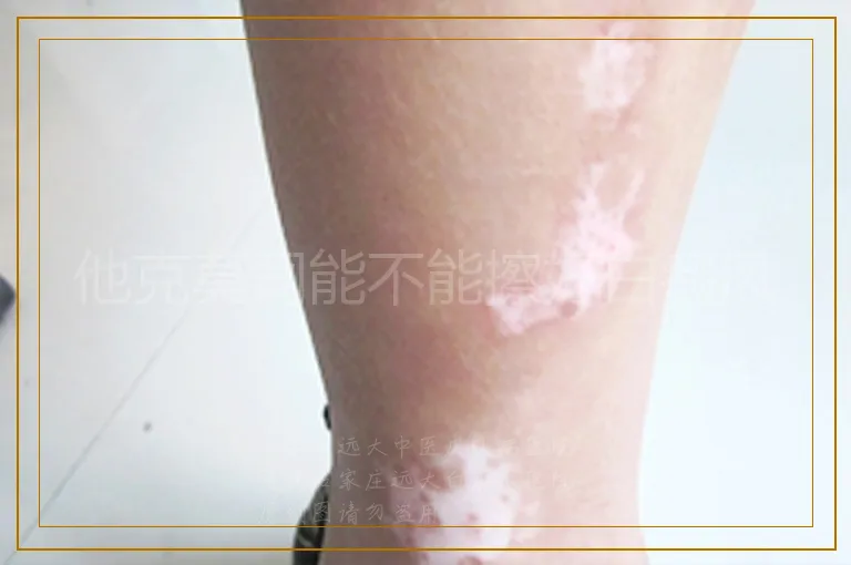 他克莫司能不能擦好白癜风