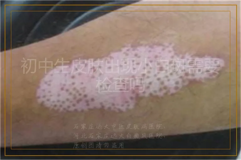 初中生皮肤出现小白斑需要检查吗