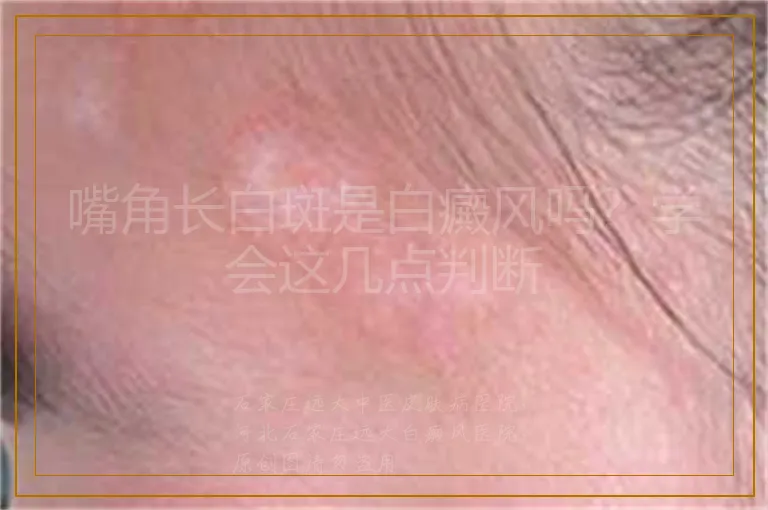 嘴角长白斑是白癜风吗？学会这几点判断