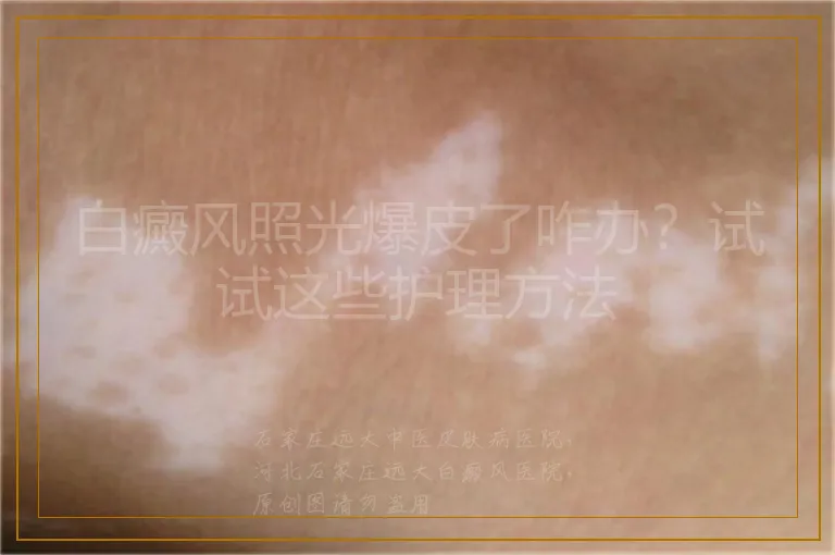 白癜风照光爆皮了咋办?试试这些护理方法