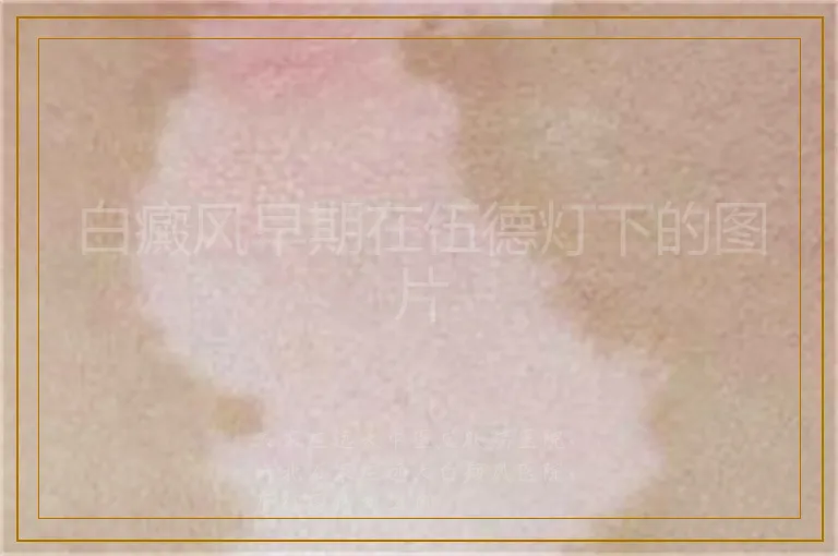 白癜风早期在伍德灯下的图片