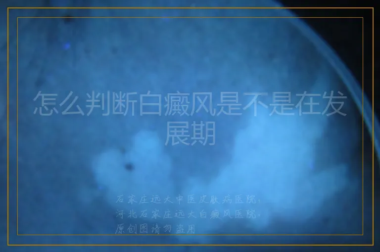 怎么判断白癜风是不是在发展期