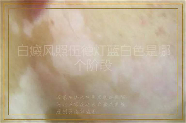 白癜风照伍德灯蓝白色是哪个阶段