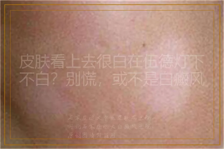 皮肤看上去很白在伍德灯下不白?别慌,或不是白癜风
