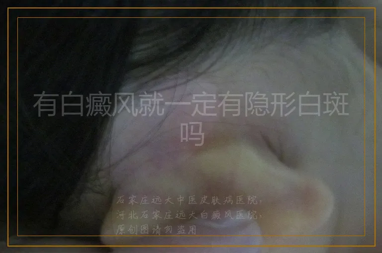 有白癜风就一定有隐形白斑吗