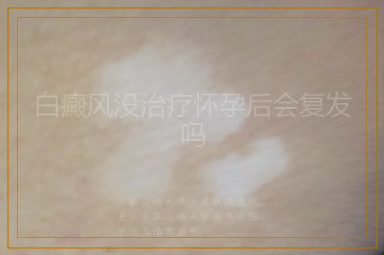 白癜风没治疗怀孕后会复发吗