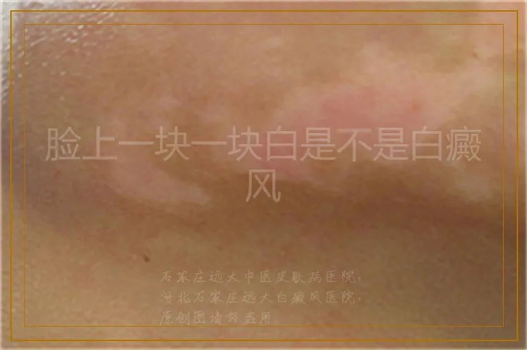 脸上一块一块白是不是白癜风