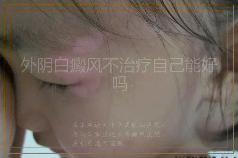外阴白癜风不治疗自己能好吗