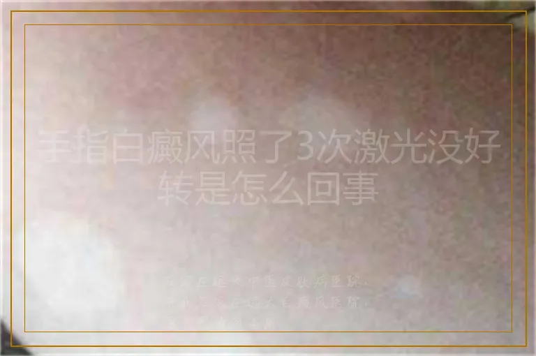 手指白癜风照了3次激光没好转是怎么回事