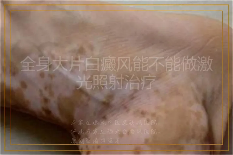 全身大片白癜风能不能做激光照射治疗