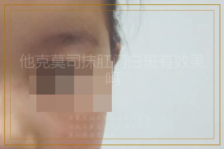 他克莫司抹肛门白斑有效果吗