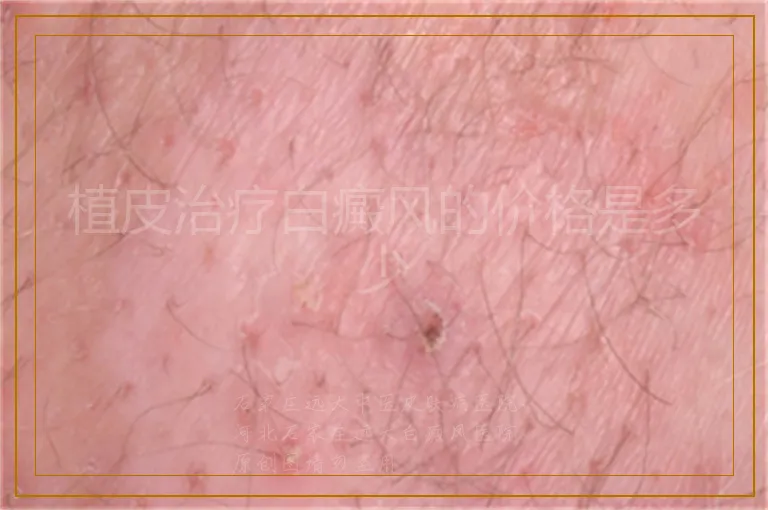 植皮治疗白癜风的价格是多少