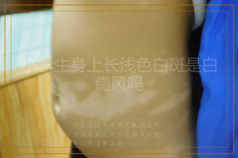 小学生身上长浅色白斑是白癜风吗