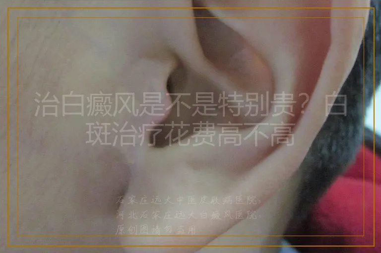 治白癜风是不是特别贵？白斑治疗花费高不高