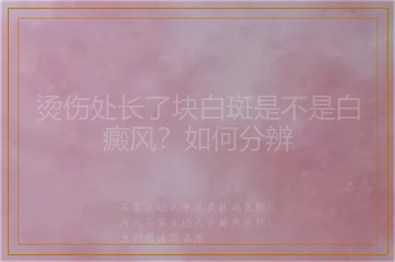 烫伤处长了块白斑是不是白癜风?如何分辨