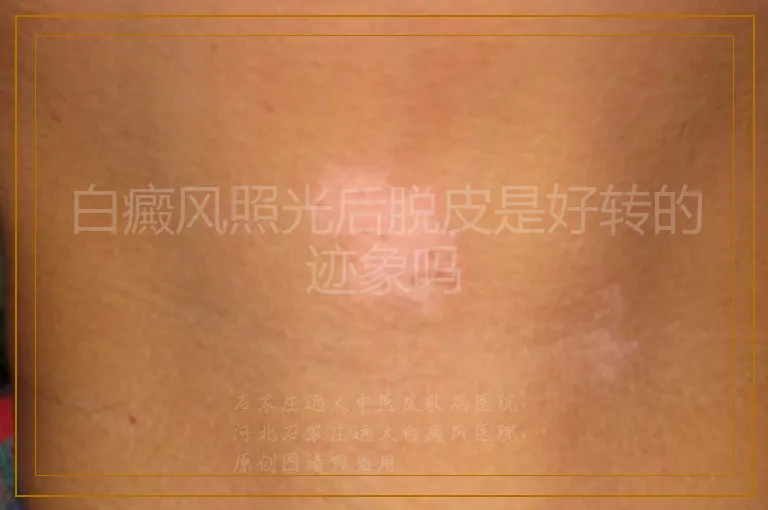 白癜风照光后脱皮是好转的迹象吗