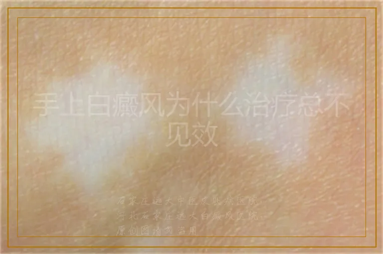 手上白癜风为什么治疗总不见效