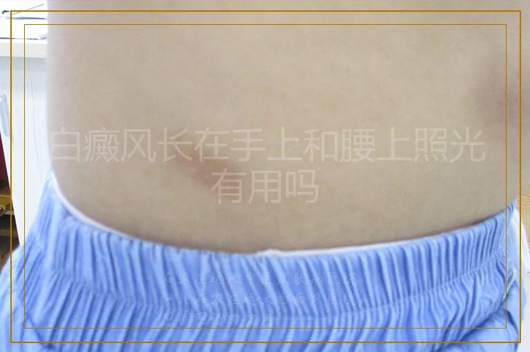 白癜风长在手上和腰上照光有用吗