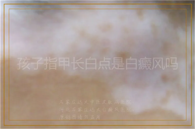 孩子指甲长白点是白癜风吗