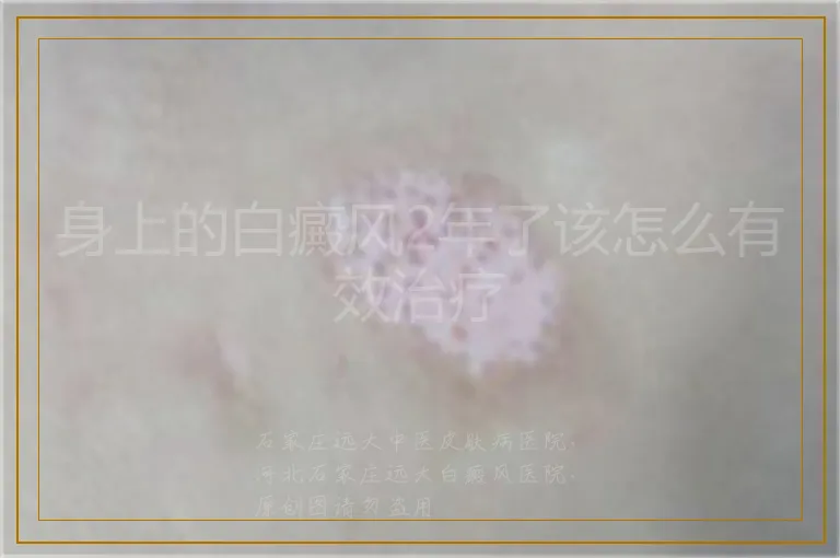 身上的白癜风2年了该怎么有效治疗
