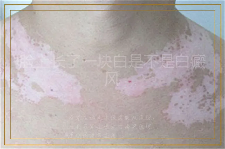 脸上长了一块白是不是白癜风