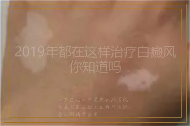 2019年都在这样治疗白癜风你知道吗
