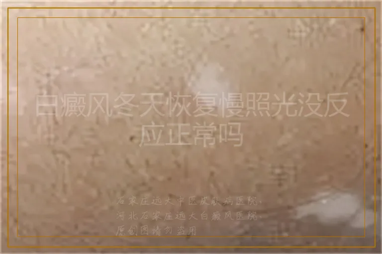 白癜风冬天恢复慢照光没反应正常吗