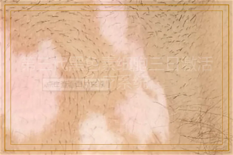 第三代黑色素细胞三日激活治疗系统