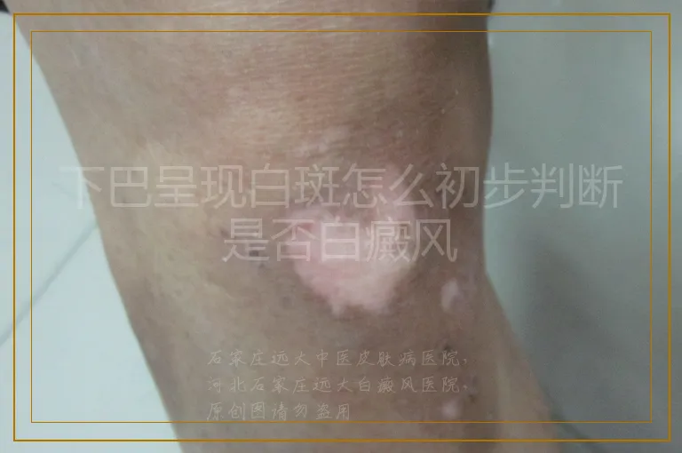 下巴呈现白斑怎么初步判断是否白癜风