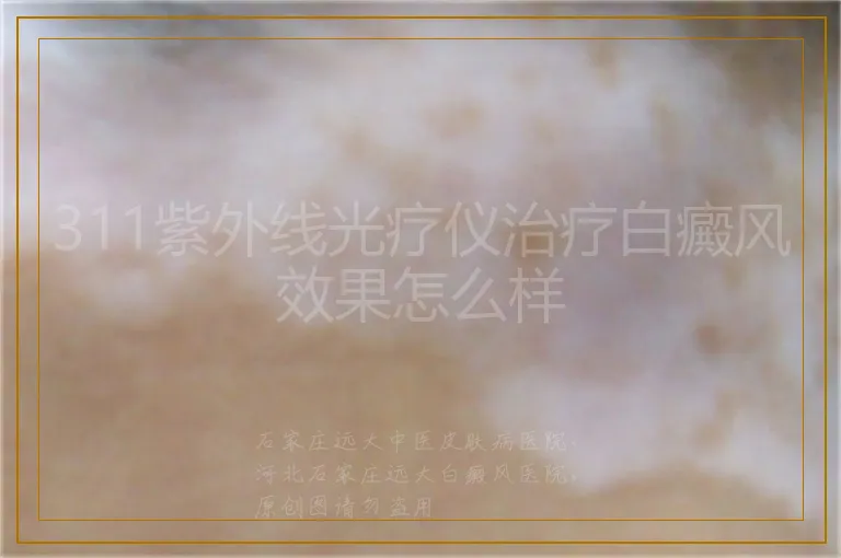 311紫外线光疗仪治疗白癜风效果怎么样