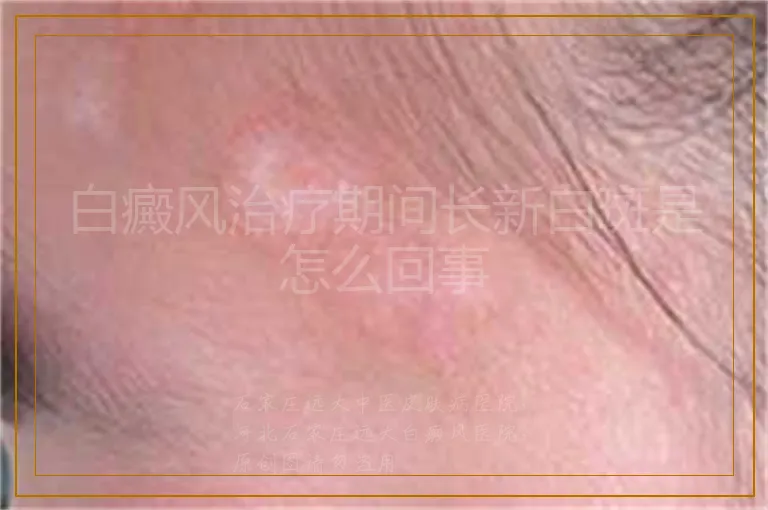 白癜风治疗期间长新白斑是怎么回事