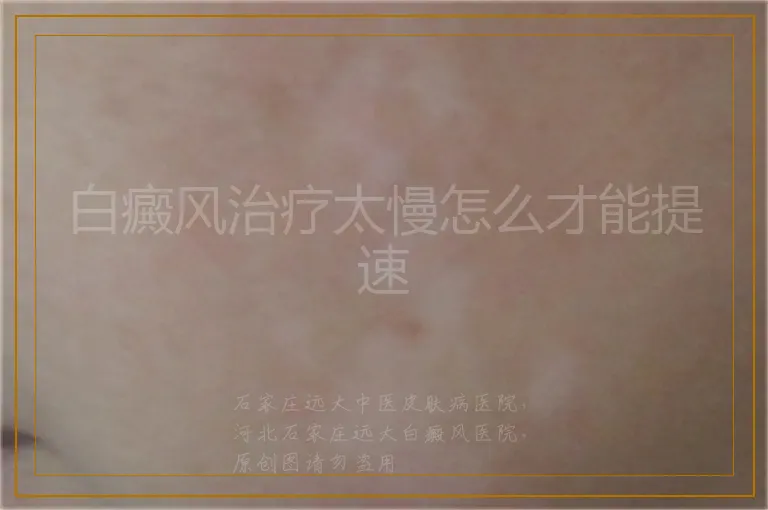 白癜风治疗太慢怎么才能提速