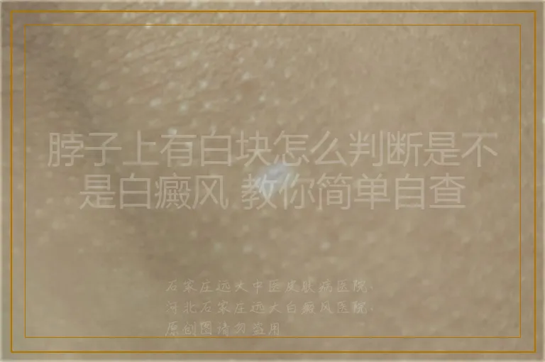 脖子上有白块怎么判断是不是白癜风 教你简单自查