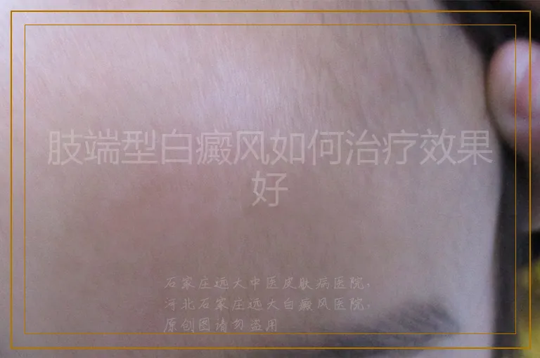 肢端型白癜风如何治疗效果好