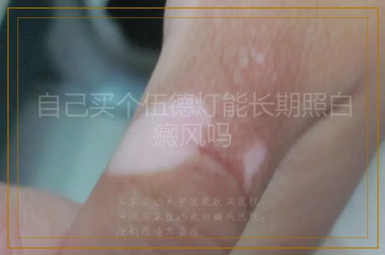 自己买个伍德灯能长期照白癜风吗