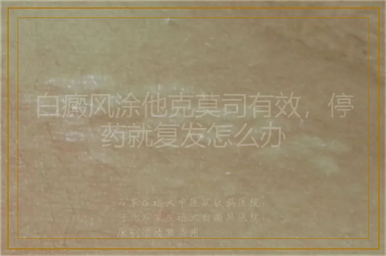 白癜风涂他克莫司有效，停药就复发怎么办