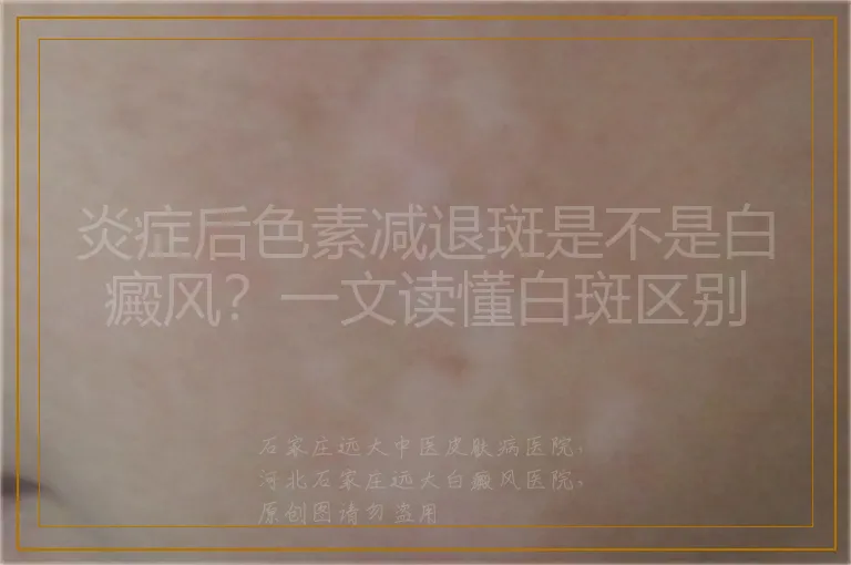 炎症后色素减退斑是不是白癜风?一文读懂白斑区别