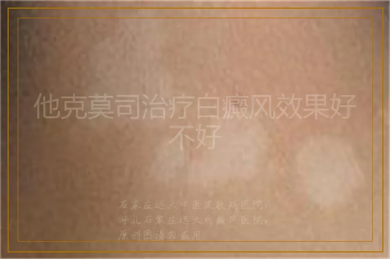 他克莫司治疗白癜风效果好不好