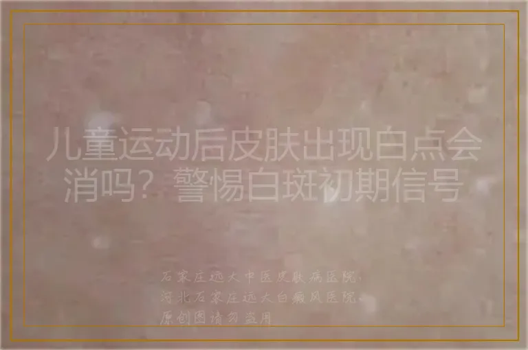 儿童运动后皮肤出现白点会消吗？警惕白斑初期信号