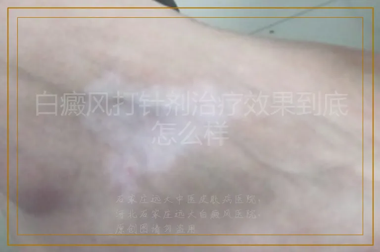 白癜风打针剂治疗效果到底怎么样