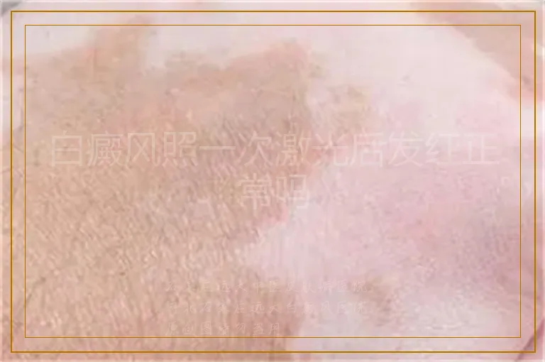 白癜风照一次激光后发红正常吗