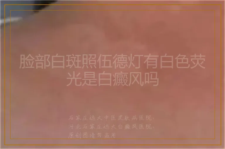 脸部白斑照伍德灯有白色荧光是白癜风吗