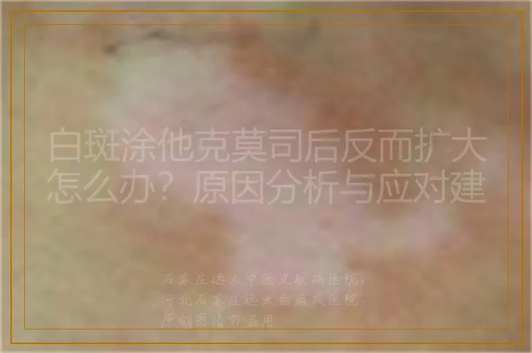 白斑涂他克莫司后反而扩大怎么办?原因分析与应对建议