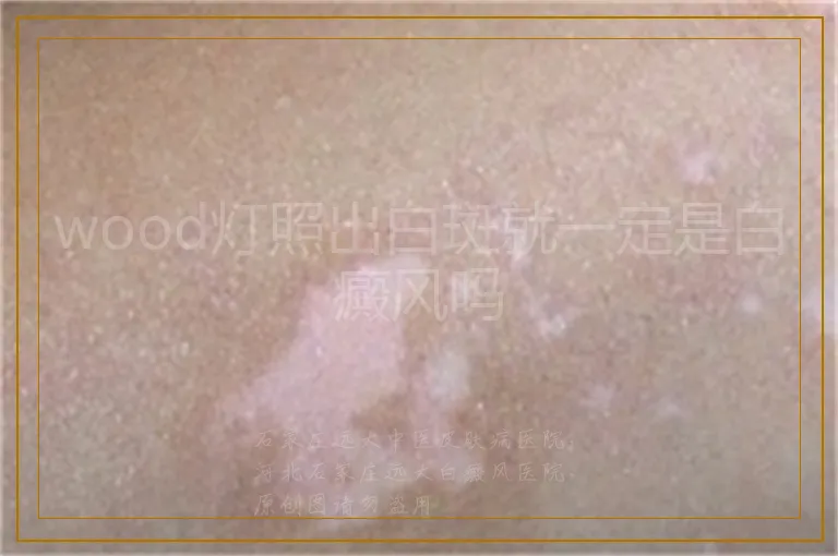 wood灯照出白斑就一定是白癜风吗