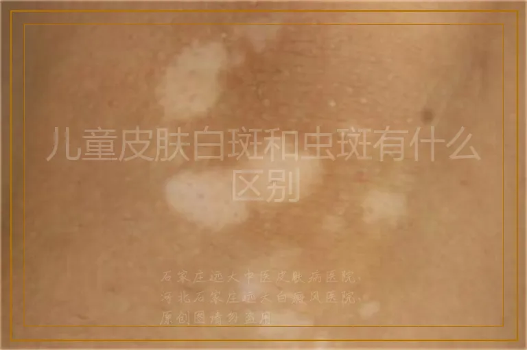 儿童皮肤白斑和虫斑有什么区别